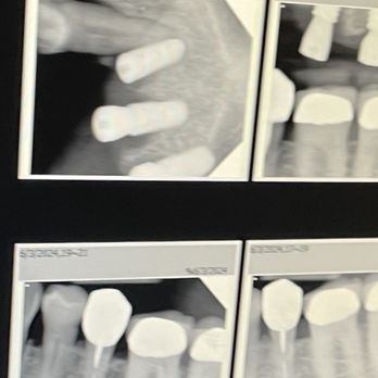 Aquarius Dental - Implant inserted into the root of my canine tooth. Had to have my canine removed thanks to this Dentist. - Cosmetic Dentists Near Me - The Colony, Texas Aquarius Dental - Implant inserted into the root of my canine tooth. Had to have my canine removed thanks to this Dentist. - Cosmetic Dentists Near Me - The Colony, Texas