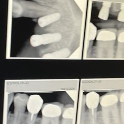 Aquarius Dental - Implant inserted into the root of my canine tooth. Had to have my canine removed thanks to this Dentist.