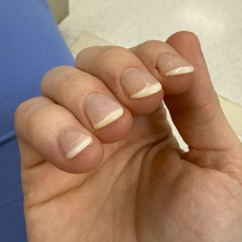 Ballston Nails & Spa - Yellowing of nail - Nail Salons Near Me - Arlington, Virginia Ballston Nails & Spa - Yellowing of nail - Nail Salons Near Me - Arlington, Virginia