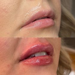 Smiley Aesthetics - Enhancing your natural beauty can be achieved with the right injector and filler.