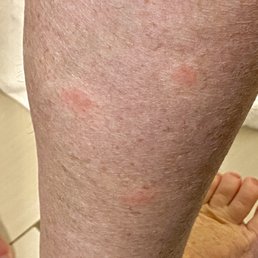 Bites on leg