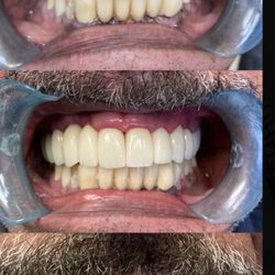 Michael D. Kim, DDS - Complete restoration of only upper arch