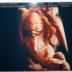 Goldenview Ultrasound 3d/4d/HD Boston MA - Ultrasound printed photo