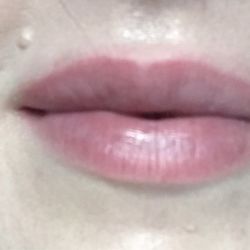 Bloom Facial Plastic Surgery - Another view of the blanching and uneven contour/Tyndall effect 2 weeks post-op.