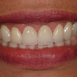 Downtown Smile Design - James C Feng, DDS - Porcelain Veneers
