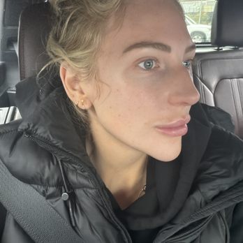 Allure Rejuvenation Center - 4 days post lip filler. No bruising. - Skin Care Near Me - Walnut Creek, California Allure Rejuvenation Center - 4 days post lip filler. No bruising. - Skin Care Near Me - Walnut Creek, California