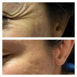 Ageless Beauty Aesthetics - Crow's feet Before/After
