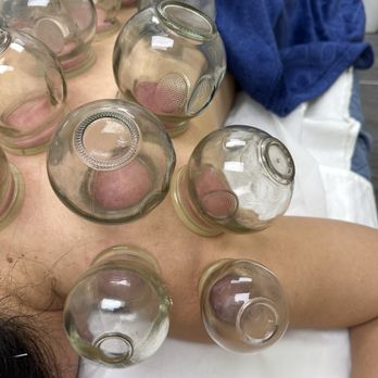 A Plus Acupuncture & Massage Therapy - Cupping session - Massage Therapy Near Me - New Hyde Park, New York
