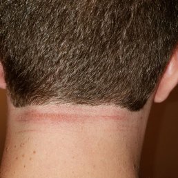 Irritated and scabbing skin from where barber nicked me Irritated and scabbing skin from where barber nicked me