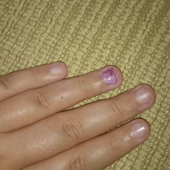 T-Nails - this is me after removing some nail polish - Nail Salons Near Me - Chicago, Illinois