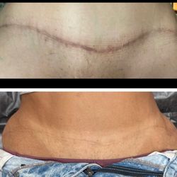 Parkway Esthetics - Scar camo on tummy tuck scar