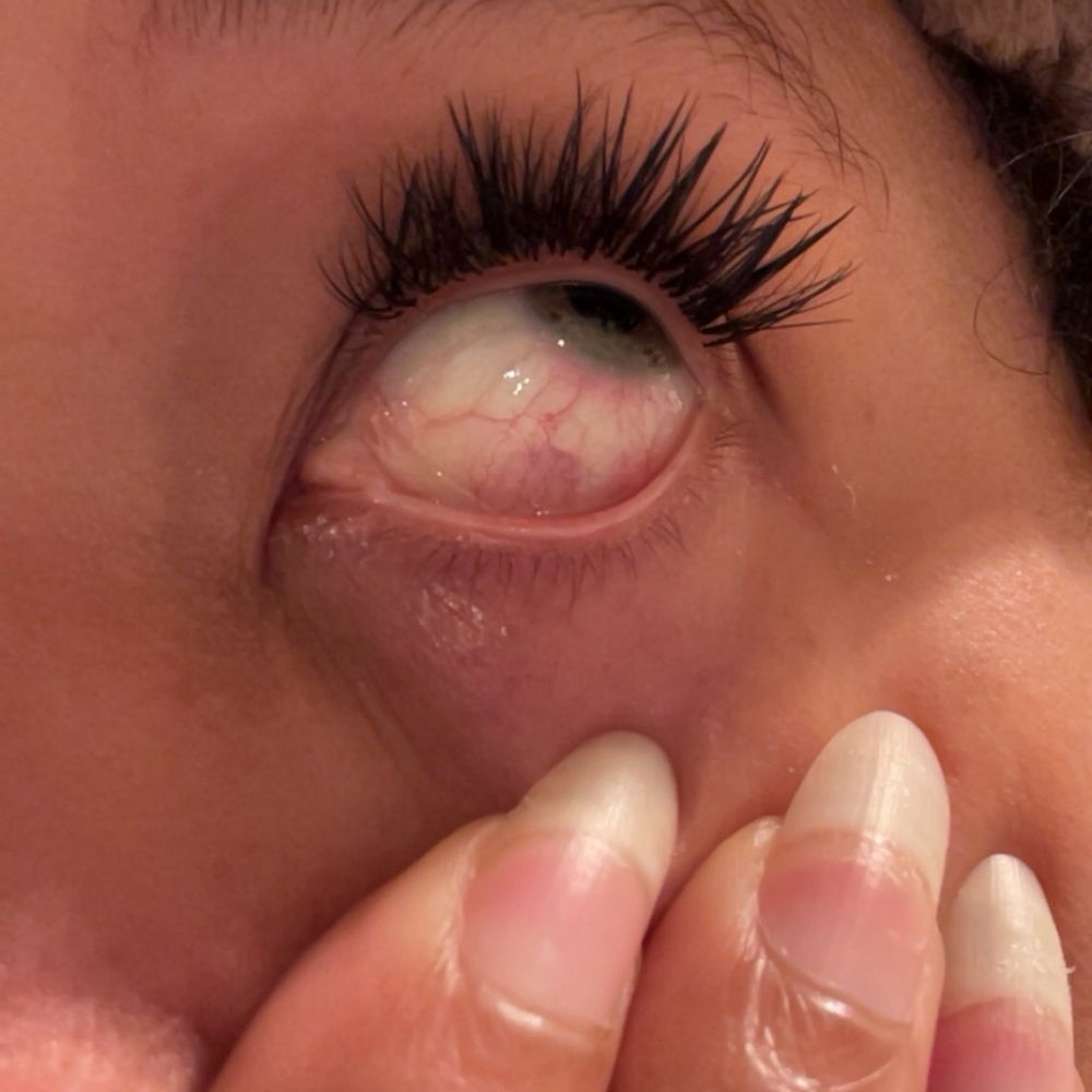 Beauty Bound - This to show the irritation from the cut on my cornea. - Waxing Near Me - South San Francisco, California Beauty Bound - This to show the irritation from the cut on my cornea. - Waxing Near Me - South San Francisco, California