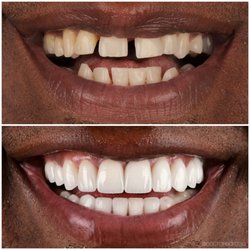 Borzoo Ahmadi, DDS - Life-changing full mouth reconstruction, using minimal and no-prep porcelain veneers.