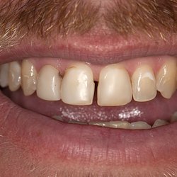 Borowski Cosmetic Dentistry - Smile before 4 veneers with old bonding and a space.