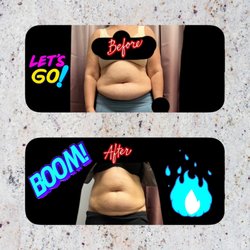 Slim Reveal Body Sculpting - Cavitation & Radiofrequency