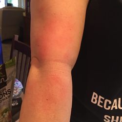 My arm after I iced it at home