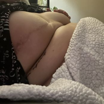 Ronald F Rosso, MD - 4 monts post op were is the clevege and the implant falls to my armpit - Cosmetic Surgeons Near Me - Torrance, California Ronald F Rosso, MD - 4 monts post op were is the clevege and the implant falls to my armpit - Cosmetic Surgeons Near Me - Torrance, California