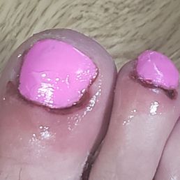 A botched pedicure!