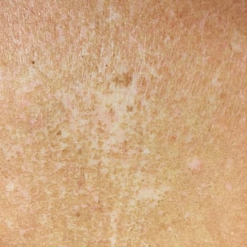 Rockstar Tan - Less than a week later this was a picture of my chest, ick! - Tanning Near Me - Costa Mesa, California Rockstar Tan - Less than a week later this was a picture of my chest, ick! - Tanning Near Me - Costa Mesa, California