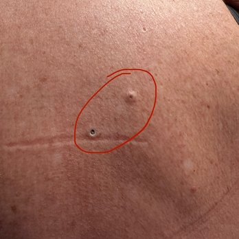 Water's Edge Dermatology - 2 cysts - Dermatologists Near Me - Vero Beach, Florida Water's Edge Dermatology - 2 cysts - Dermatologists Near Me - Vero Beach, Florida