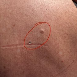 Water's Edge Dermatology - 2 cysts