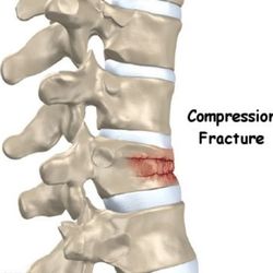 Kevin D Richardson, DO - San Antonio Spine Center - Compression Fracture