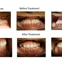 Ipro Dental - Orthodontic Treatment
