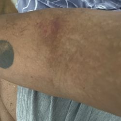 Ochsner St. Anne Hospital - That's pictures of my arms. I guess they kept missing my veins,