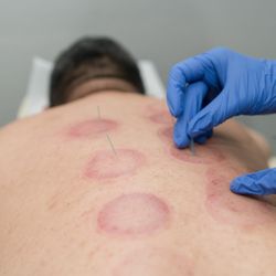 Nguyen Chiropractic - Cupping and stim needles