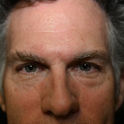 Lorne K Rosenfield, MD - Peninsula Plastic Surgery - Before picture