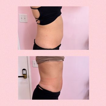Sassy Med Spa - 2 sessions of Lemon Bottle and 4 sessions of body contouring - Medical Spas Near Me - Sherman Oaks, California Sassy Med Spa - 2 sessions of Lemon Bottle and 4 sessions of body contouring - Medical Spas Near Me - Sherman Oaks, California