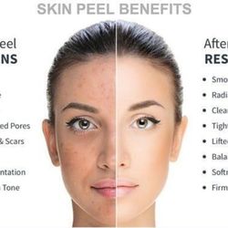Skin Care by the Bay - Chemical Peel Benefits