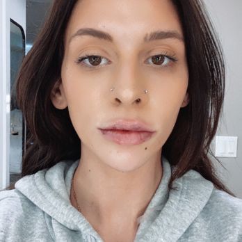 JT Aesthetic - Front view day 1 after getting Botox and lip filler - Tattoo Removal Near Me - Eastvale, California JT Aesthetic - Front view day 1 after getting Botox and lip filler - Tattoo Removal Near Me - Eastvale, California
