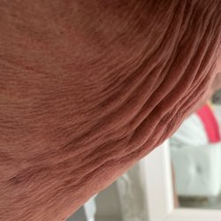 Post op minor in office lipo surgery. Legs never had any wrinkles in them.