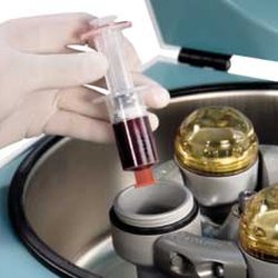 Philippe Loriaut - Le PRP, Platelet Rich Plasma ou Plasma Riche en Plaquettes, est du plasma sanguin enrichi en plaquettes par une centrifugation.