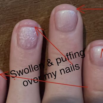 Lee Nail - Day one, you can see skin your bed is puffing up over my nail they're so short - Nail Salons Near Me - Frederick, Maryland Lee Nail - Day one, you can see skin your bed is puffing up over my nail they're so short - Nail Salons Near Me - Frederick, Maryland