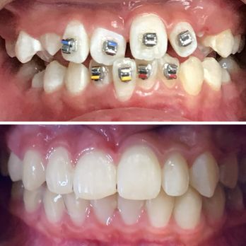 Prestige Orthodontics - Before and After photo - Orthodontists Near Me - La Verne, California Prestige Orthodontics - Before and After photo - Orthodontists Near Me - La Verne, California