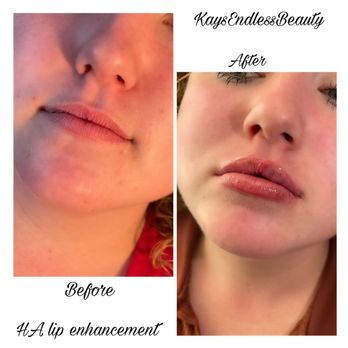 KaysEndlessBeauty - HA lip enhancement - Body Contouring Near Me KaysEndlessBeauty - HA lip enhancement - Body Contouring Near Me