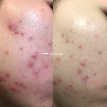 Derma Plus Skin Care - Acne Extractions - Skin Care Near Me - Monterey Park, California Derma Plus Skin Care - Acne Extractions - Skin Care Near Me - Monterey Park, California