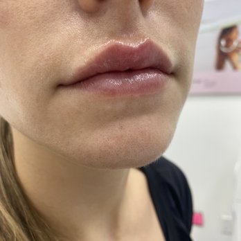 LaserAway - Juvederm lips - Laser Hair Removal Near Me - Walnut Creek, California