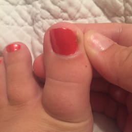 One week after pedicure, it is very painful & this is after I have been putting medicine on it for about 3 days. One week after pedicure, it is very painful & this is after I have been putting medicine on it for about 3 days.