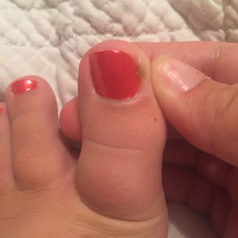 Living Colors Nails - One week after pedicure, it is very painful & this is after I have been putting medicine on it for about 3 days. - Nail Salons Near Me - Austin, Texas Living Colors Nails - One week after pedicure, it is very painful & this is after I have been putting medicine on it for about 3 days. - Nail Salons Near Me - Austin, Texas