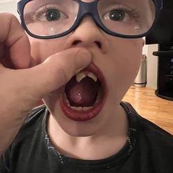 Pine Grove Dental Arts - Broken teeth
