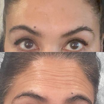 The Skntellect Studio - Bottom is before and look at the top no more map on my forehead. I love this place. - Medical Spas Near Me - Burbank, California The Skntellect Studio - Bottom is before and look at the top no more map on my forehead. I love this place. - Medical Spas Near Me - Burbank, California