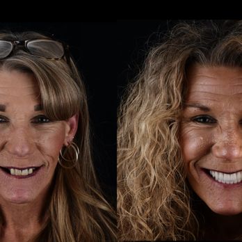 Winfield Dental Group - Upper and lower full mouth tooth replacement with implants. Teeth removed, implants were placed, and teeth were fixed in the mouth same day - Prosthodontists Near Me - San Diego, California Winfield Dental Group - Upper and lower full mouth tooth replacement with implants. Teeth removed, implants were placed, and teeth were fixed in the mouth same day - Prosthodontists Near Me - San Diego, California
