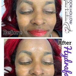 Brookhollow Obstetrics & Gynecology - Hydrafacial uses potentes technology to cleanse, extract and hydrate. HydraFacial super serums are made with nourishing ingredients.