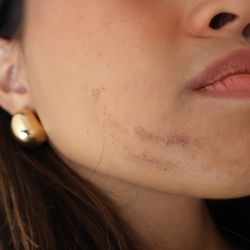 Skin Fix Med Spa - 3 days after the hydrofacial