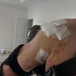 Pinnacle Orthopaedics - Approx 2-3wks after surgery