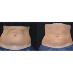 Darcy Skincare - Coolsculpting of the flanks and abdomen.