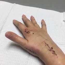 Ethan W Blackburn, MD - Immediately after soft cast taken off. As you can see, my thumb was seen in tight. 3mo of PT & home exercises got it back to normal.